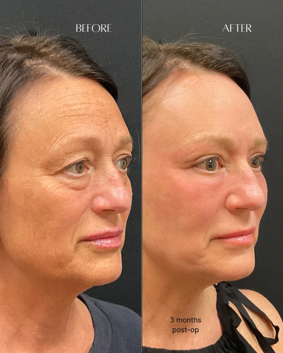 Before and after oculofacial plastic surgery results in Atlanta, GA, performed by Dr. Sahitya Reddy.