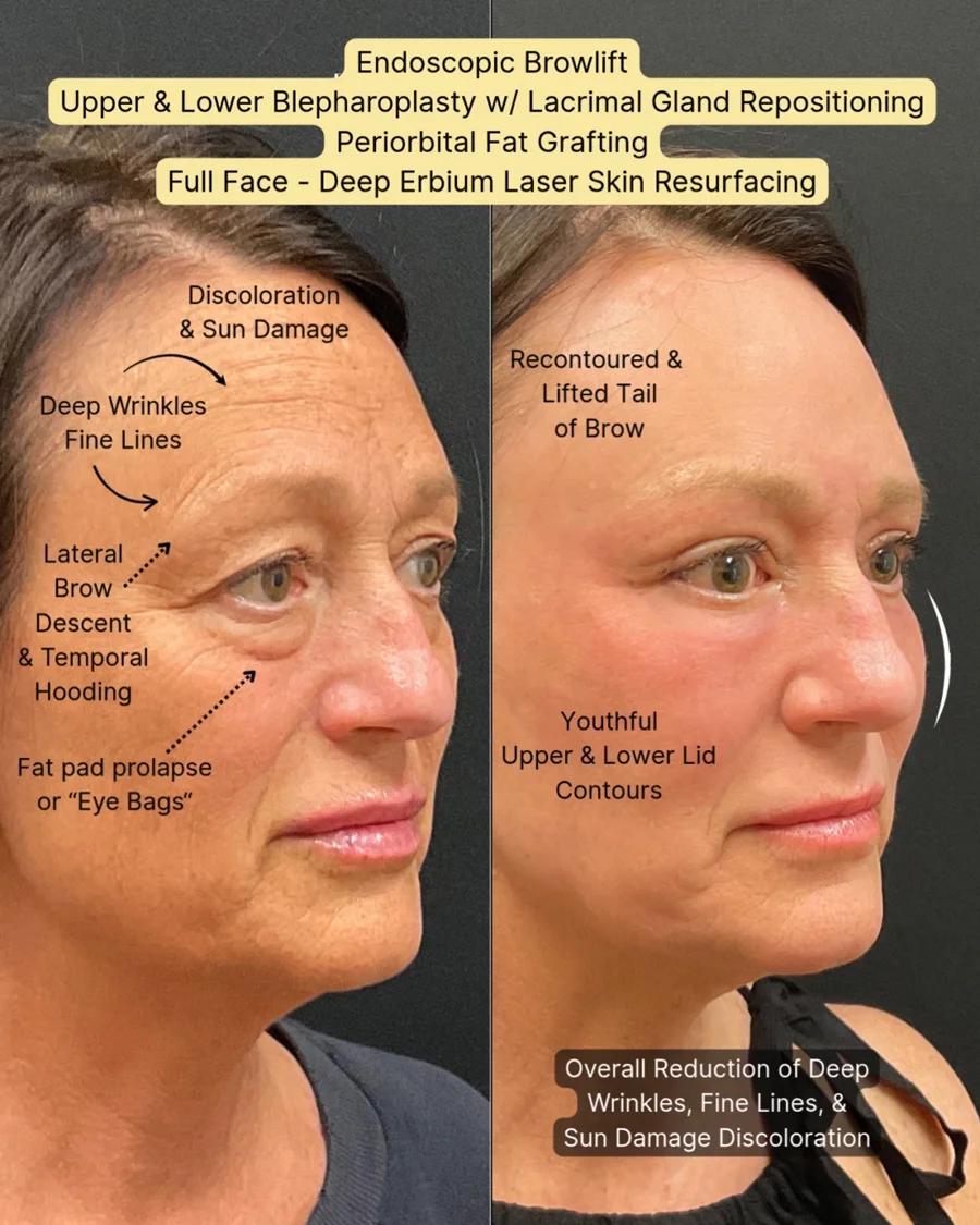 Before and after oculofacial plastic surgery results in Atlanta, GA, performed by Dr. Sahitya Reddy.