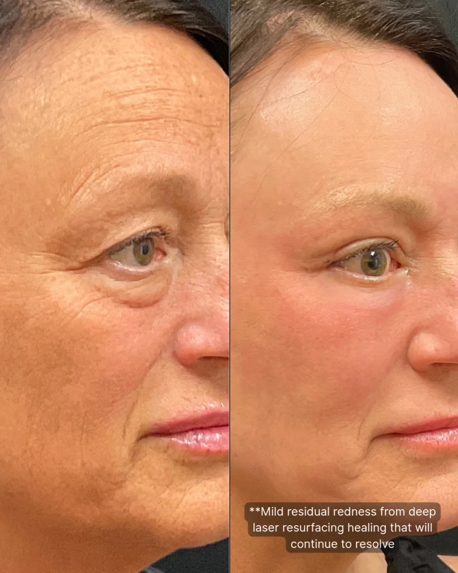 Before and after oculofacial plastic surgery results in Atlanta, GA, performed by Dr. Sahitya Reddy.