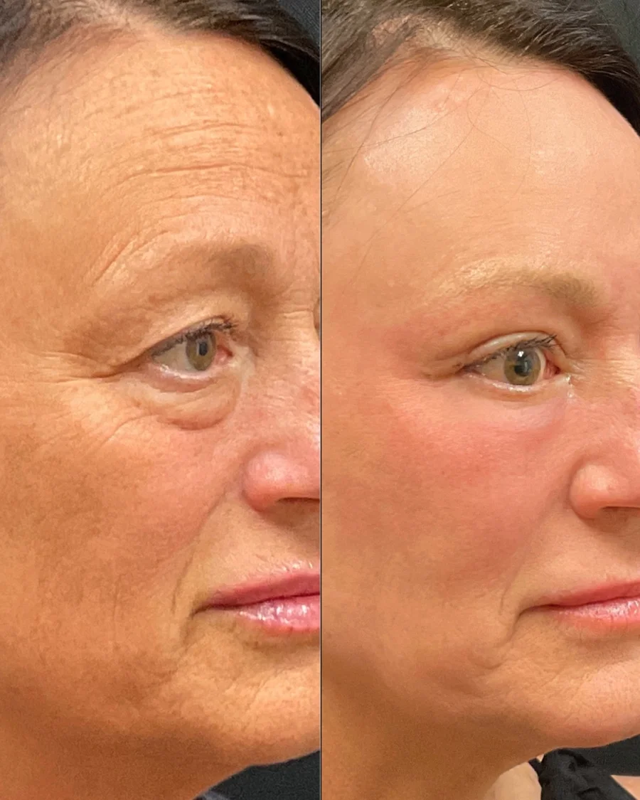 Before and after oculofacial plastic surgery results in Atlanta, GA, performed by Dr. Sahitya Reddy.